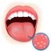 Обсуждаем лечение кандидоза полости рта. Узнаем советы врачей и специалистов.